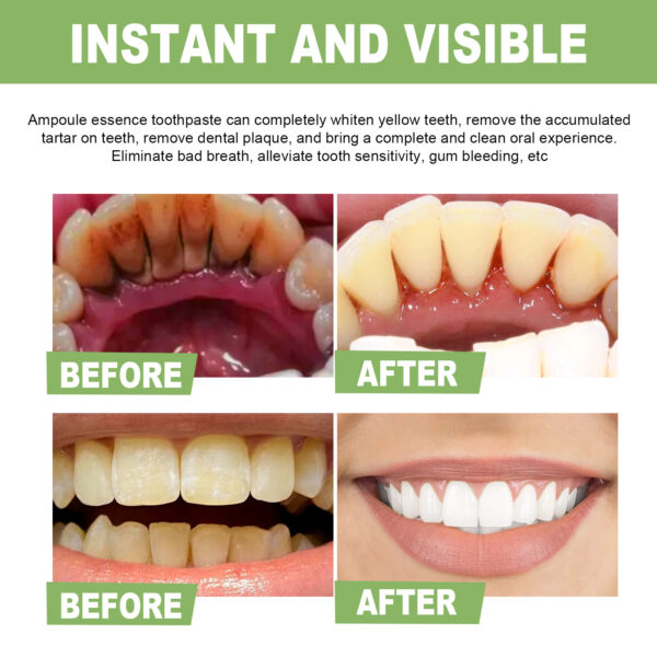 EELHOE Teeth Whitening Essence Cleans Tooth Stains Mouth Odor Beautiful Teeth Brightening Teeth Cleaning Essence - Image 5